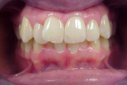 Before Invisalign
